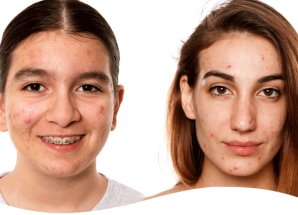 What Is The Difference Between Puberty Acne And Adult Acne?