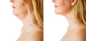 Fat Dissolving Injections - Kybella
