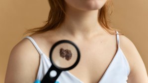 What Kills Melanoma Cells Naturally?