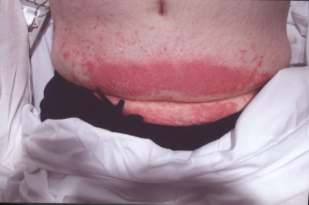 Is Psoriasis the Bane of Your Life?