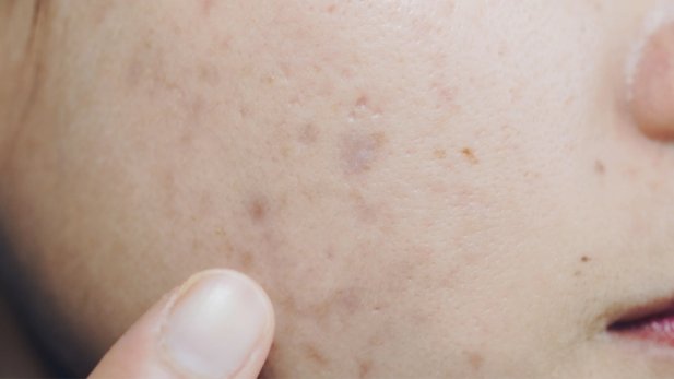 Acne Marks And Acne Scars  Difference And Prevention Tips