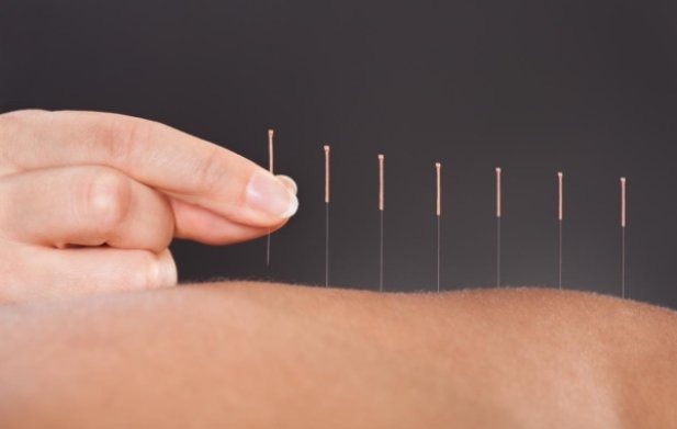 Is Acupuncture A Complementary Therapy For Weight Loss?