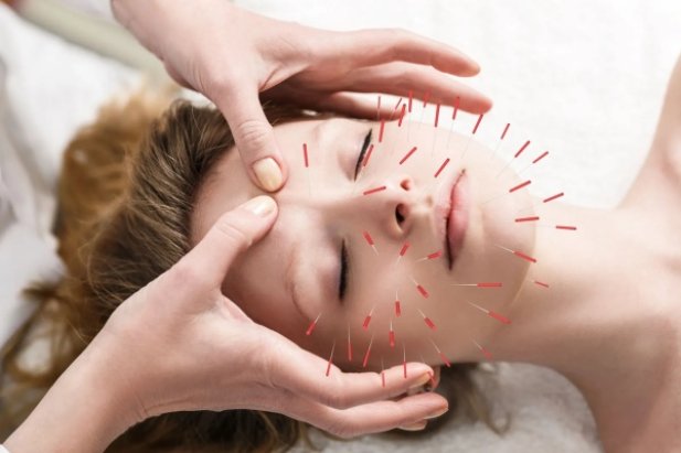 What is Traditional Chinese Acupuncture Style And Techniques?