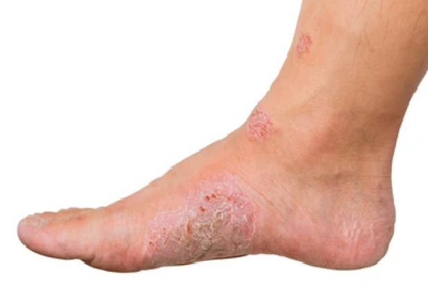 Ivermectin for Humans: Tackling Worms, Scabies, and More