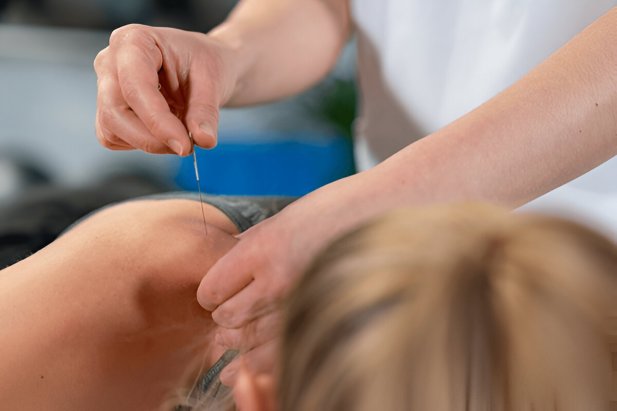 How Acupuncture Calms the Mind and Rebalances the Body