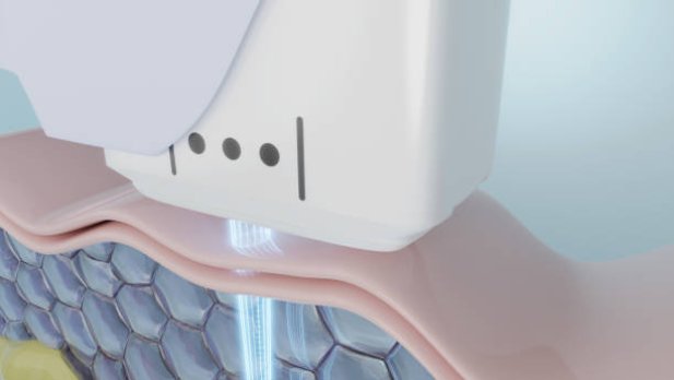 9 Reasons to Try Aerolase Laser for Your Skin Concerns