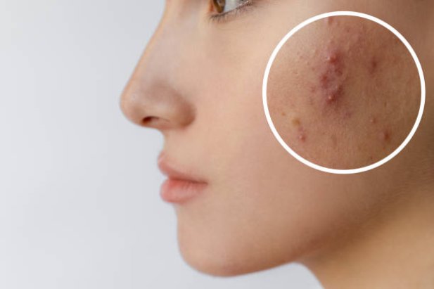 Why Teen Skin Needs a Custom Acne Clearing Program Now