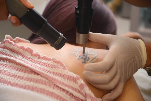Avoiding Infections During Tattoo Removal in Islamabad