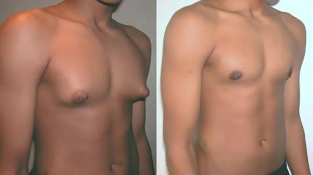 What Is the System of Gynecomastia? Understanding Its Mechanism and Treatment